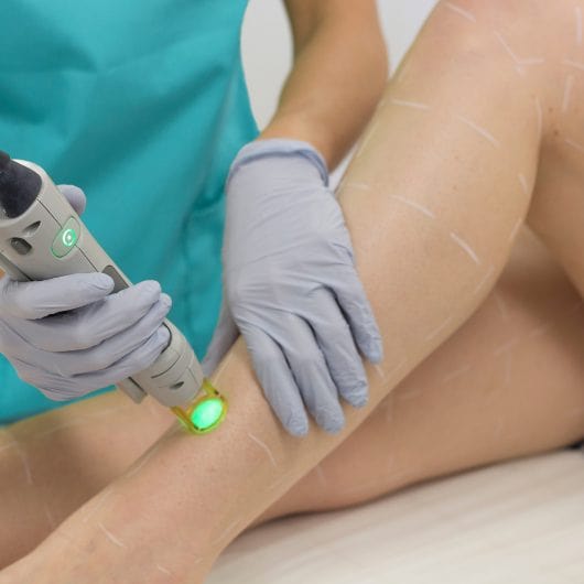 Laser Treatment