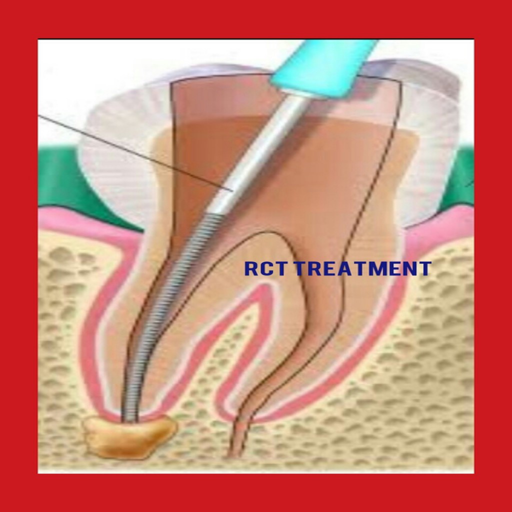 RCT Treatment